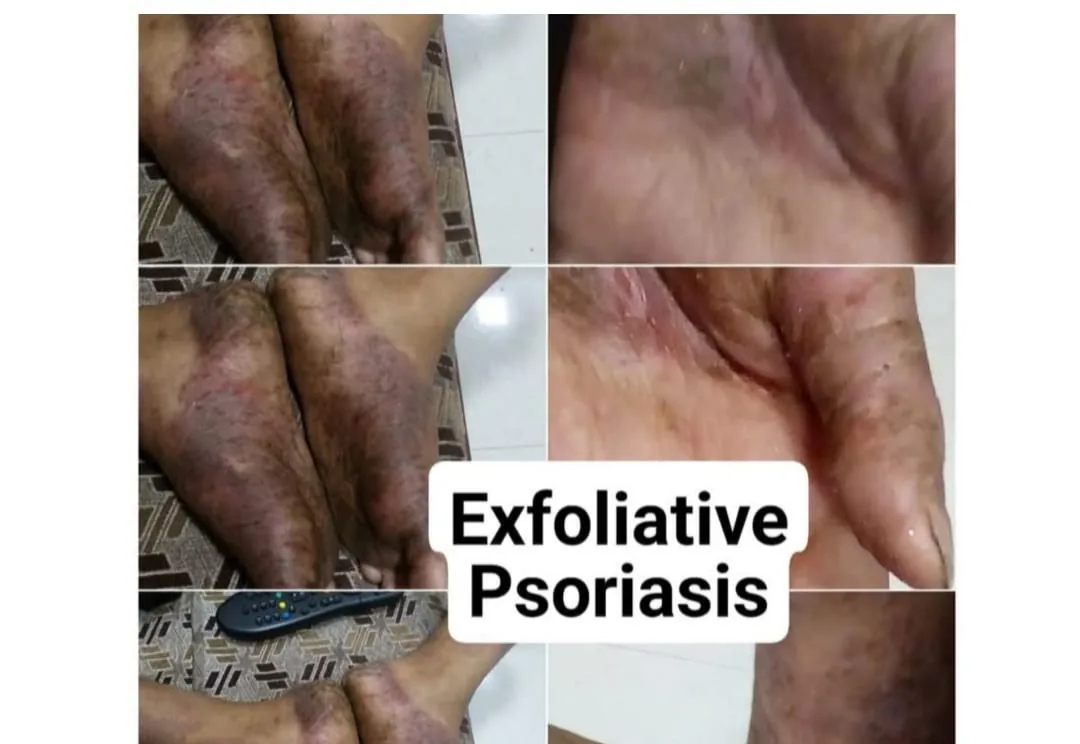 Exfoliative psoriasis before and after homeopathic treatment