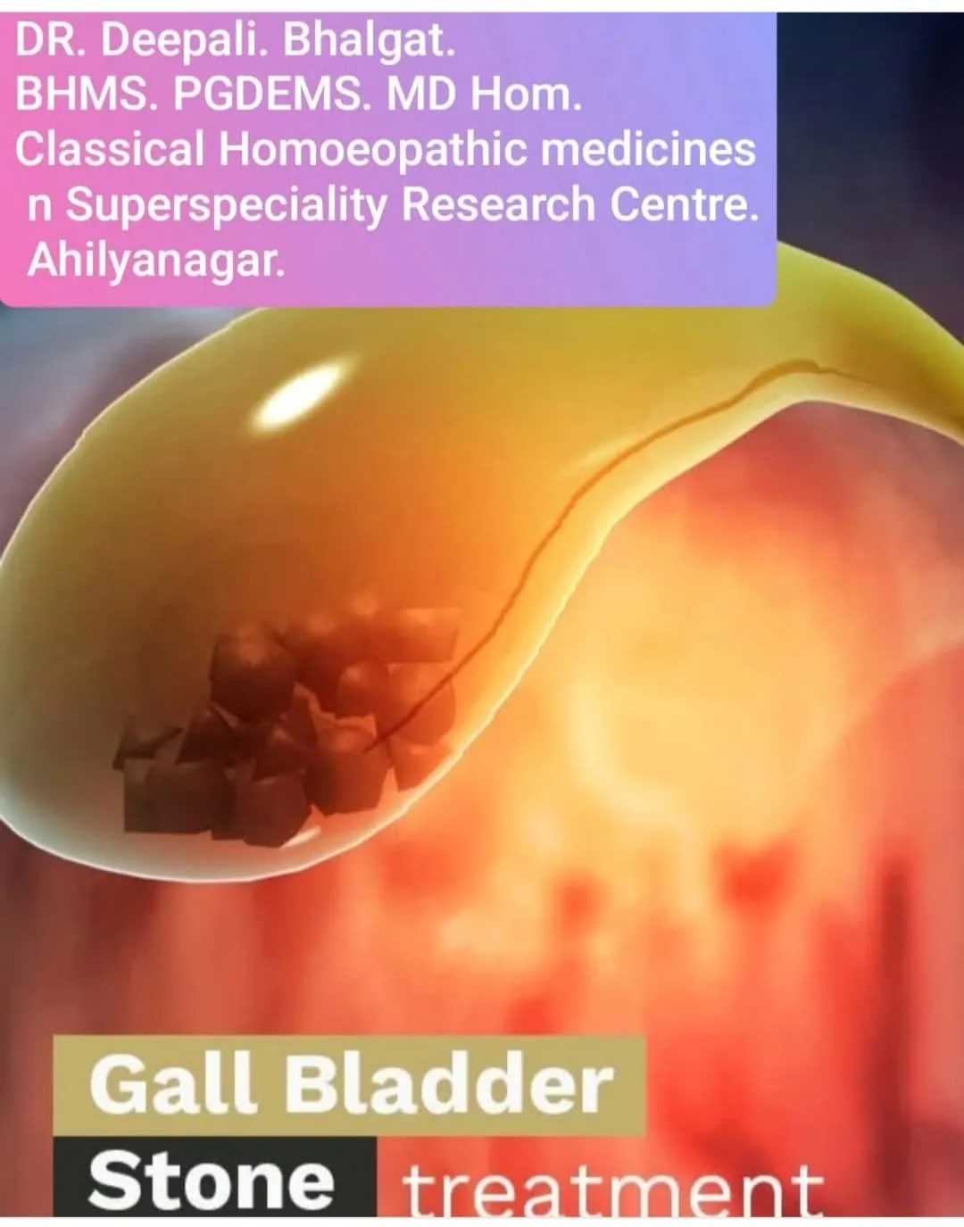 Gallbladder stone homeopathic treatment illustration