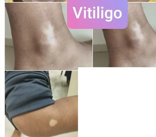 Vitiligo before and after homeopathic treatment